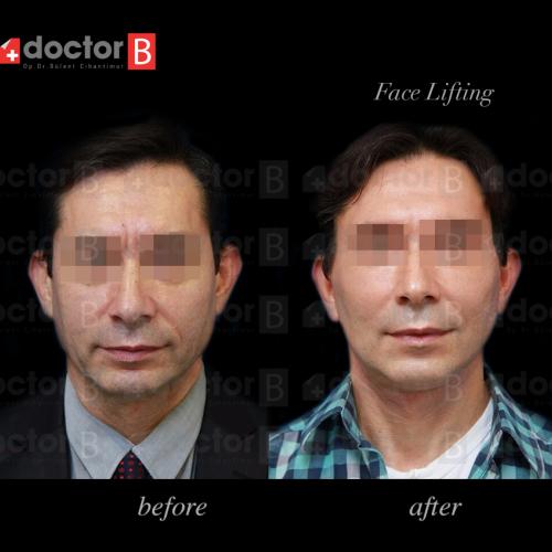 Before after photos of our patients 10